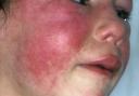 Scarlet fever cases have been reported at an East Lothian primary school. Symptoms include a deep skin rash and a flushed face. The image used is a stock image