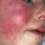 Scarlet fever cases have been reported at an East Lothian primary school. Symptoms include a deep skin rash and a flushed face. The image used is a stock image